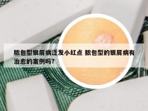 脓包型银屑病泛发小红点 脓包型的银屑病有治愈的案例吗?