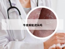 牛皮癣能烫头吗