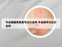 牛皮癣腿疼患者可以针灸吗 牛皮癣可以扎针灸吗