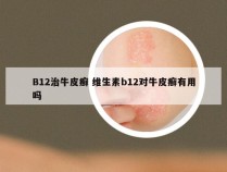 B12治牛皮癣 维生素b12对牛皮癣有用吗