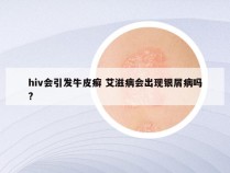 hiv会引发牛皮癣 艾滋病会出现银屑病吗?