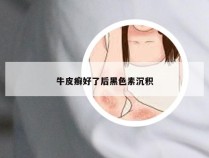 牛皮癣好了后黑色素沉积