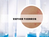 甘肃牛皮癣 牛皮肤癣价格