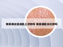 银屑病会造成脸上浮肿吗 银屑病脸会红肿吗