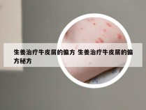 生姜治疗牛皮屑的偏方 生姜治疗牛皮屑的偏方秘方