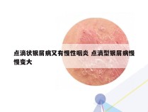 点滴状银屑病又有慢性咽炎 点滴型银屑病慢慢变大