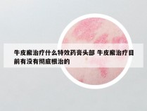 牛皮廨治疗什么特效药膏头部 牛皮廨治疗目前有没有彻底根治的