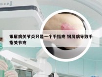 银屑病关节炎只是一个手指疼 银屑病导致手指关节疼