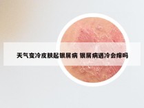 天气变冷皮肤起银屑病 银屑病遇冷会痒吗