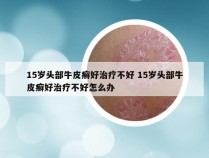 15岁头部牛皮癣好治疗不好 15岁头部牛皮癣好治疗不好怎么办