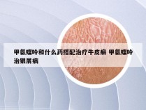 甲氨蝶呤和什么药搭配治疗牛皮癣 甲氨蝶呤治银屑病