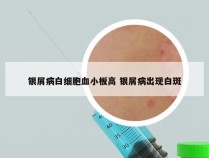 银屑病白细胞血小板高 银屑病出现白斑