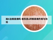 维A治银屑病吗 维生素a对银屑病作用与功效