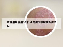 红皮病银屑病10年 红皮病型银屑病会传染吗