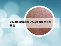 2023银屑病市场 2021年银屑病有望根治