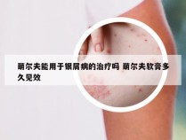 萌尔夫能用于银屑病的治疗吗 萌尔夫软膏多久见效