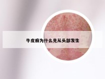 牛皮癣为什么先从头部发生