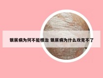 银屑病为何不能根治 银屑病为什么攻克不了