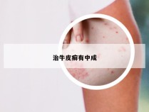 治牛皮癣有中成