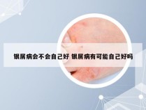 银屑病会不会自己好 银屑病有可能自己好吗