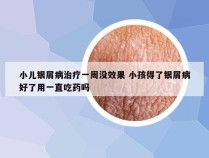 小儿银屑病治疗一周没效果 小孩得了银屑病好了用一直吃药吗