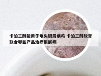 卡泊三醇能用于龟头银屑病吗 卡泊三醇软膏联合哪些产品治疗银屑病