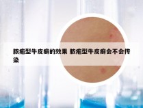 脓疱型牛皮癣的效果 脓疱型牛皮癣会不会传染