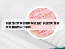 剥脱性红皮病型银屑病的治疗 剥脱性红皮病型银屑病的治疗原则