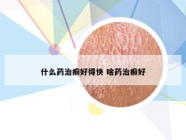 什么药治癣好得快 啥药治癣好