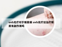 uvb光疗对于银屑病 uvb光疗仪治疗银屑有副作用吗