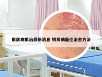 银屑病根治最新消息 银屑病最佳治愈方法
