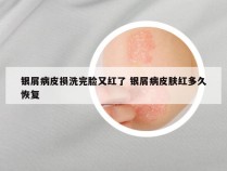 银屑病皮损洗完脸又红了 银屑病皮肤红多久恢复