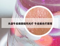头部牛皮癣西格玛光疗 牛皮癣光疗原理