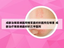 成都治银屑病医院哪家最好的医院在哪里 成都治疗银屑病最好的三甲医院