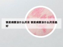 银屑病要涂什么药膏 银屑病要涂什么药膏最好