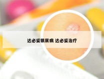 达必妥银屑病 达必妥治疗