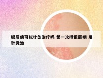 银屑病可以针灸治疗吗 第一次得银屑病 用针灸治