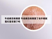 牛皮癣没有银屑 牛皮癣没有银屑了也不痒就是红是见强了吗