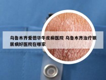 乌鲁木齐爱德华牛皮癣医院 乌鲁木齐治疗银屑病好医院在哪家