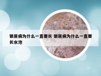 银屑病为什么一直要长 银屑病为什么一直要长水泡