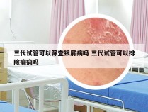 三代试管可以筛查银屑病吗 三代试管可以排除癫痫吗