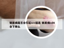 银屑病是否会引起scc超高 银屑病cd4会下降么