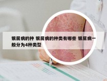 银屑病的种 银屑病的种类有哪些 银屑病一般分为4种类型