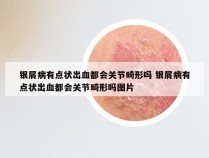 银屑病有点状出血都会关节畸形吗 银屑病有点状出血都会关节畸形吗图片