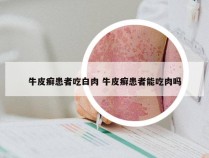 牛皮癣患者吃白肉 牛皮癣患者能吃肉吗
