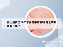 身上的白斑10年了会是牛皮癣吗 身上有白斑好几年了