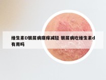 维生素D银屑病瘙痒减轻 银屑病吃维生素d有用吗