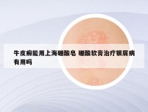 牛皮癣能用上海硼酸皂 硼酸软膏治疗银屑病有用吗