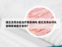 康王洗发水能治疗银屑病吗 康王洗发水对头部银屑病是否有效?