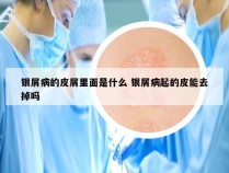 银屑病的皮屑里面是什么 银屑病起的皮能去掉吗